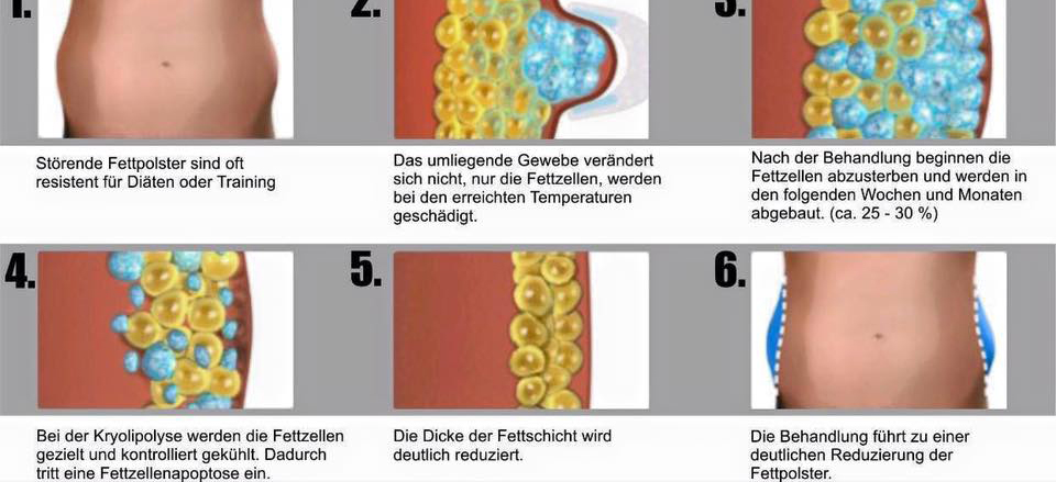 kryolipolyse_bild2_